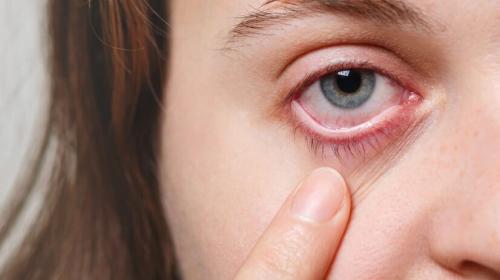 Conjunctivitis