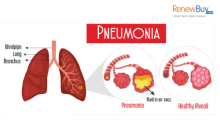 Pneumonia Symptoms, Causes, and Treatments